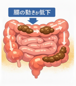 ダイエットで食事量が減り腸の動きが低下して便が溜まりやすくなっている状態のイラスト